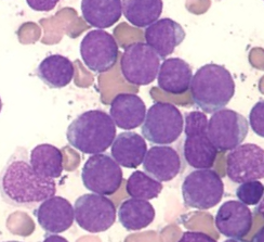Acute myeloid leukemia (AML) Peripheral Blood Plasma