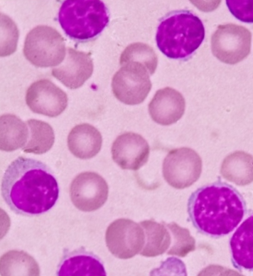 Chronic lymphocytic leukemia (CLL)  Plasma