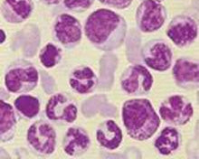 Chronic myeloid leukemia (CML)